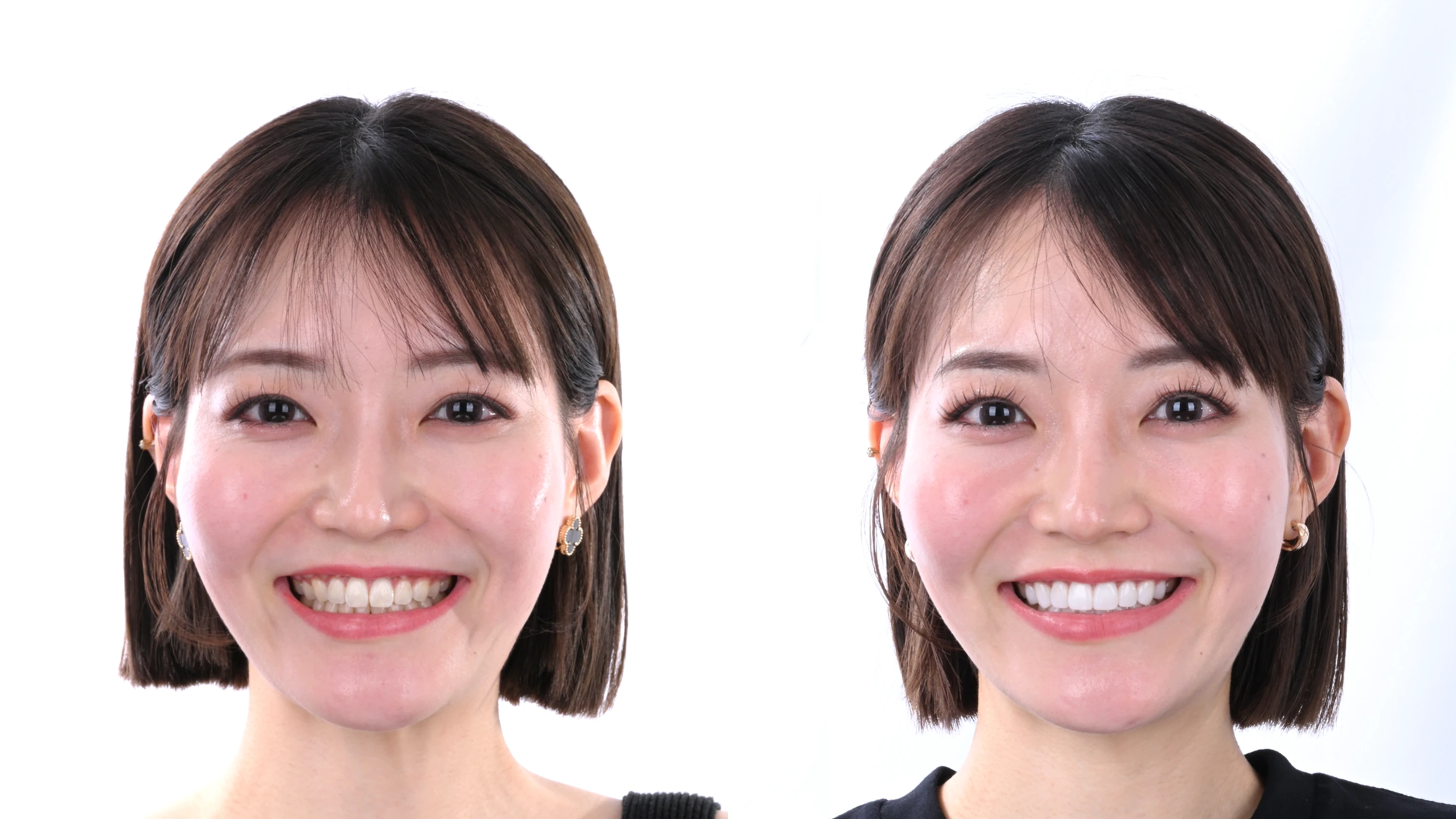 矯正後の実症例