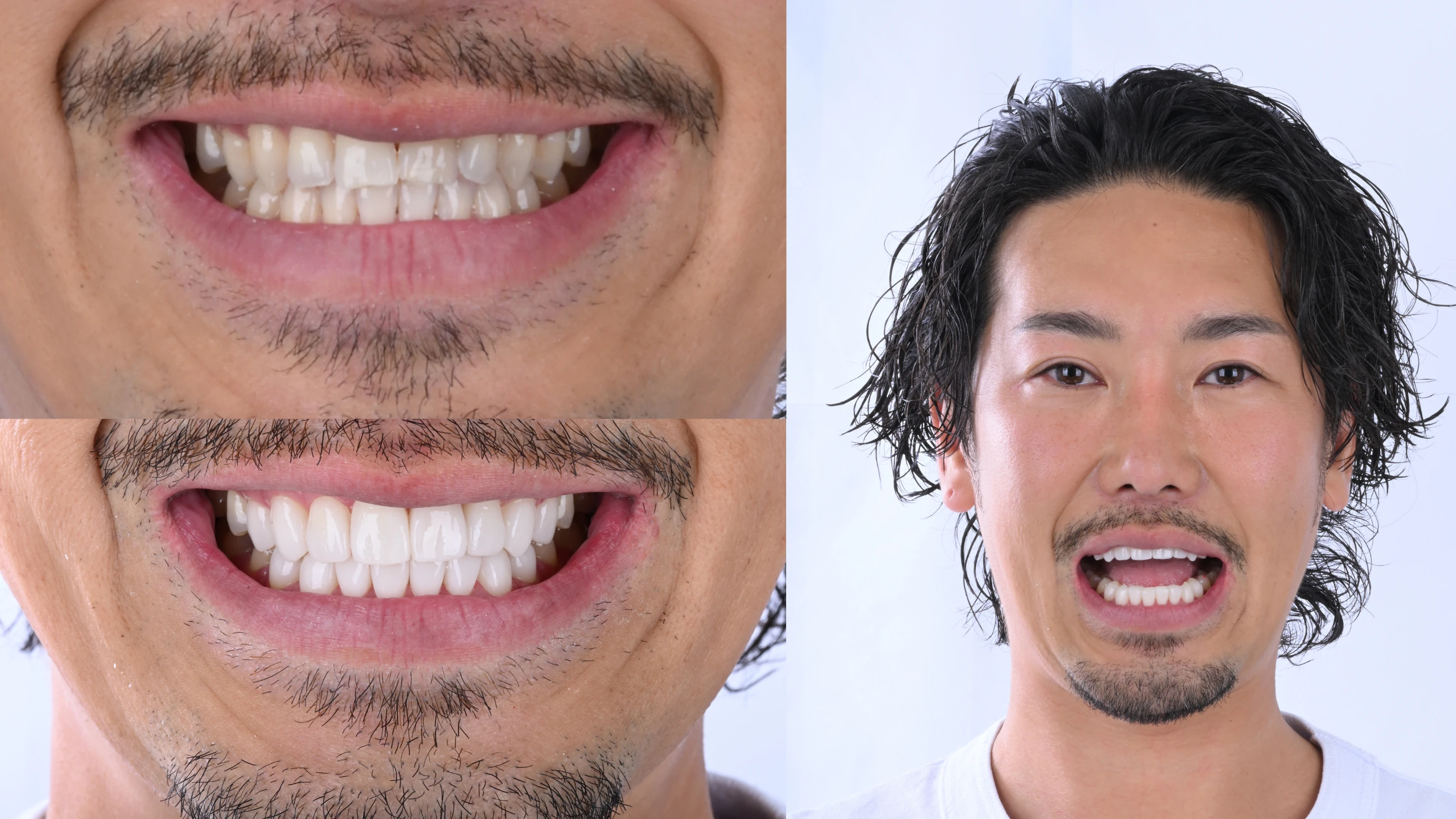 歯を削りたくない実症例