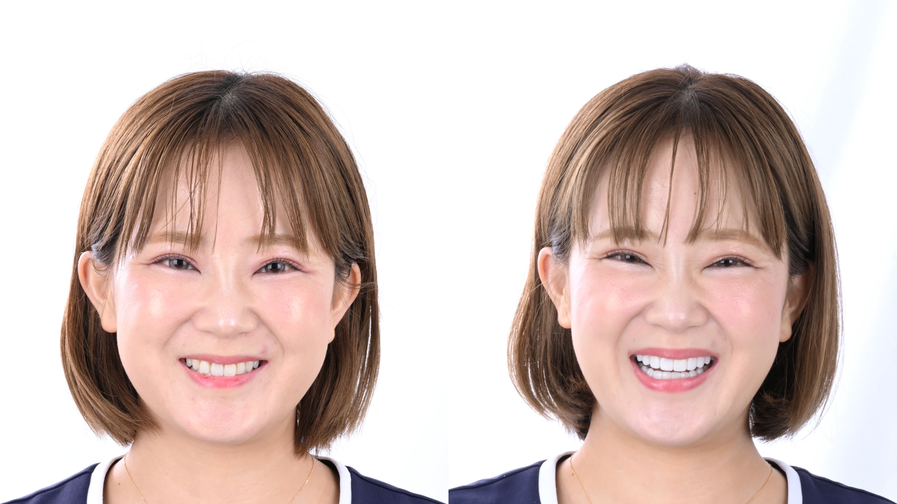 スマイル改善の実症例